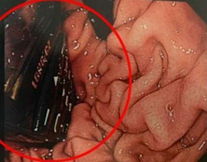 爱尔兰男子生吞手机：胃部X光不忍直视